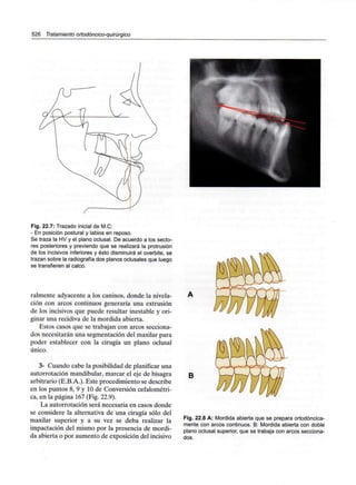 526 Tratamiento ortodóncico-quirúrgico
Fig. 22.7: Trazado inicial de M.C:
- En posición postural y labios en reposo.
Se traza la HV y el plano oclusal. De acuerdo a los secto-
res posteriores y previendo que se realizará la protrusión
de los incisivos inferiores y ésto disminuirá el overbite, se
trazan sobre la radiografía dos planos oclusales que luego
se transfieren al calco.
raímente adyacente a los caninos, donde la nivela-
ción con arcos continuos generaría una extrusión
de los incisivos que puede resultar inestable y ori-
ginar una recidiva de la mordida abierta.
Estos casos que se trabajan con arcos secciona-
dos necesitarán una segmentación del maxilar para
poder establecer con la cirugía un plano oclusal
único.
3- Cuando cabe la posibilidad de planificar una
autorrotación mandibular, marcar el eje de bisagra
arbitrario (E.B.A.). Este procedimiento se describe
en los puntos 8, 9 y 10 de Conversión cefalométri-
ca, en la página 167 (Fig. 22.9).
La autorrotación será necesaria en casos donde
se considere la alternativa de una cirugía sólo del
maxilar superior y a su vez se deba realizar la
impactación del mismo por la presencia de mordi-
da abierta o por aumento de exposición del incisivo
B
Fig. 22.8 A: Mordida abierta que se prepara ortodóncica-
mente con arcos continuos. B: Mordida abierta con doble
plano oclusal superior, que se trabaja con arcos secciona-
dos.
 