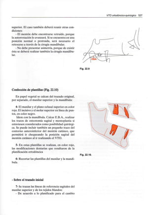 VTO ortodóncico-quirúrgico 527
superior. El caso también deberá reunir otras con-
diciones:
- El mentón debe encontrarse retruido, porque
la autorrotación lo avanzará. Si se encuentra en una
posición normal o protruida, será necesario el
retroceso a través de la cirugía mandibular.
- No debe presentar asimetría, porque de existir
ésta se deberá realizar también la cirugía mandibu-
lar.
Fig. 22.9
Confección de plantillas (Fig. 22.10)
En papel vegetal se calcan del trazado original,
por separado, el maxilar superior y la mandíbula:
4- El maxilar y el plano oclusal superior en color
rojo. El incisivo y el molar superior en línea de pun-
tos, en color negro.
ídem con la mandíbula. Calcar E.B.A., realizar
los trazos de osteotomía sagital y mentoplastia si
estuviesen considerados como posibilidad quirúrgi-
ca. Se puede incluir también un pequeño trazo del
contorno anteroinferior del mentón cutáneo, que
permitirá ir chequeando la posición sagital del
mentón cutáneo al ir realizando el VTO.
5- En estas plantillas se realizan, en color rojo,
las modificaciones dentarias que resultaron de la
planificación ortodóncica
6- Recortar las plantillas del maxilar y la mandí-
bula.
Fig. 22.10.
- Sobre el trazado inicial
7- Se trazan las líneas de referencia sagitales del
maxilar superior y de los tejidos blandos:
- De acuerdo a lo planificado para el cambio
 