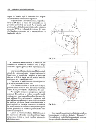 528 Tratamiento ortodóncico-quirúrgico
sagital del maxilar sup. Se traza una línea perpen-
dicular a la HV desde el nuevo punto A.
- Se puede trazar también una línea perpendicu-
lar a la HV desde el punto Sn, calculando que su
posición responderá en un 30 % al cambio del
punto A óseo. Esta línea permitirá, en los próximos
pasos del VTO, ir evaluando la posición del men-
tón blando representado por el trazo realizado en
la plantilla inferior.
Fig. 22.11.
8- Cuando es posible intentar la corrección con
autorrotación mandibular, realizando sólo la cirugía
del maxilar superior, proceder de la siguientemanera:
- Unir las plantillas maxilar y mandibularcoinci-
diendo los planos oclusales y con correcto overjet
Superponer la mandíbula y realizar la autorrota-
ción en el E.B.A hasta que el incisivo superior
quede con una exposición normal.
- Observar si la posición resultante del punto A
y de los incisivos es adecuada o no.
- Si no resulta adecuada se puede ajustar algo la
posición de los incisivos para mejorar el resultado,
dentro de las posibilidades ortodóncicas del caso.
- Por ejemplo: si se desea una posición algo más
avanzada del punto A, se podrán potruir los incisi-
vos inferiores para poder ubicar el maxilarsuperior
más adelante. Si por el contrario, resulta una posi-
ción adelantada del punto A, se podrán retruir algo
los incisivos inferiores. Estos cambios dentarios se
pueden planificar sin alejar demasiado los incisivos
de las normas de inclinación con respecto al plano
oclusal, y teniendo en cuenta las posibilidades orto-
dóncicas de lograrlos.
- Cuando la posición resultante del Punto A y de
los incisivos sea adecuada, pero el mentón no llega a
una posición óptima, se puede planificar una mento-
plastia de avance.
Fig. 22.12.
- Sino se puede alcanzar un resultado apropiado en
lo que respecta a posiciones dentarias y del punto A y
Po, se elimina la posibilidad de una cirugía monoma-
xilar y se planificará una cirugía bimaxilar.
 