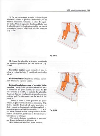 VTO ortodóncico-quirúrgico 529
9- En los casos donde se deba realizar cirugía
bimaxilar, cortar la plantilla mandibular por la
línea de osteotomía realizada a la altura del segun-
do molar. Unir el segmento distal mandibular con
la plantilla superior haciendo coincidir los planos
oclusales en correcta relación de overbite y overjet
(Fig 22.13).
Fig. 22.13
10- Llevar las plantillas al trazado manejando
los siguientes parámetros para su ubicación (Fig.
22.14):
En sentido sagital: hacer coincidir el pto. A
sobre la vertical del pto. A planificada en el calco
inicial.
En sentido vertical: lograr una correcta exposi-
ción del incisivo superior (3mm).
Inclinación del plano oclusal o "rotación" de las
plantillas: Dentro de los parámetros normales para
la inclinación del plano oclusal, que es de 7 a 10°
con respecto a la HV, se rotarán las plantillas
(haciendo fulcrum en el punto A) para lograr una
posición del Po coincidente con la Vertical del
punto A.
Cuando se eleva el sector posterior del plano
oclusal, la proyección del mentón disminuye (Fig.
22.16). Cuando desciende el sector posterior, es
decir, cuando se horizontaliza el plano oclusal, el
mentón se proyecta hacia delante (Fig. 22.15).A su
vez, estos cambios inciden en la posición e inclina-
ción de los incisivos, por lo que se deberá observar
también que se obtenga:
- Un incisivo inferior coincidente, o unos mm
por delante de la vertical del punto A.
- Una inclinación adecuada de los incisivos.
Fig. 22.14
 