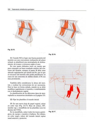 530 Tratamiento ortodóncico-quirúrgico
Fig. 22.15.
Fig. 22.16.
11- Cuando NO se logre una buena posición del
mentón con una conveniente inclinación del plano
oclusal, se planificará una mentoplastia de desliza-
miento, de avance o retroceso según el caso.
En este punto debemos tener en cuenta que
para conseguir un buen resultado estético del con-
torno del mentón, siempre el punto B debe estar
ubicado sagitalmente por detrás del Po, por lo que
el retroceso del mentón sólo podrá planificarse en
casos de una anatomía de sínfisis donde el Po sea
muy prominente.
También debe considerarse la altura del men-
tón, y realizar las correcciones de ser necesarias.
Esto se hace en forma aislada, cuando no se debe
modificar sagitalmente el mentón, o combinándolo
con el deslizamiento sagital.
La planificación de los diferentes tipos de men-
toplastia se encuentran detallados en la página 533.
12- Fijar las plantillas al trazado inicial.
13- En una nueva hoja de papel vegetal, calcar
en color rojo (Fig. 22.17): Base de cráneo, HV,
maxilar sup. y mandíbula de las plantillas (con los
dientes del VTO).
En la mandíbula, calcar todos los trazos quirúr-
gicos, de cuerpo y mentón si hubiera. Por último,
en color negro, calcar del trazado inicial espina
nasal anterior y posterior.
Fig. 22.17.
 