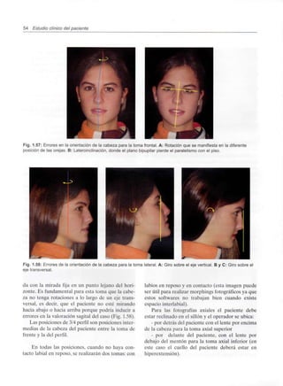 54 Estudio clínico del paciente
Fig. 1.57: Errores en la orientación de la cabeza para la toma frontal. A: Rotación que se manifiestaen la diferente
posición de las orejas. B: Lateroinclinación,donde el plano bipupilar pierde el paralelismocon el piso.
Fig. 1.58: Errores de la orientación de la cabeza para la toma lateral.A: Giro sobre el eje vertical. B y C: Giro sobre el
eje transversal.
da con la mirada fija en un punto lejano del hori-
zonte. Es fundamental para esta toma que la cabe-
za no tenga rotaciones a lo largo de un eje trans-
versal, es decir, que el paciente no esté mirando
hacia abajo o hacia arriba porque podría inducir a
errores en la valoración sagital del caso (Fig. 1.58).
Las posiciones de 3/4 perfil son posiciones inter-
medias de la cabeza del paciente entre la toma de
frente y la del perfil.
En todas las posiciones, cuando no haya con-
tacto labial en reposo, se realizarán dos tomas: con
labios en reposo y en contacto (esta imagen puede
ser útil para realizar morphings fotográficos ya que
estos softwares no trabajan bien cuando existe
espacio interlabial).
Para las fotografías axiales el paciente debe
estar reclinado en el sillón y el operador se ubica:
- por detrás del paciente con el lente por encima
de la cabeza para la toma axial superior
- por delante del paciente, con el lente por
debajo del mentón para la toma axial inferior (en
este caso el cuello del paciente deberá estar en
hiperextensión).
 