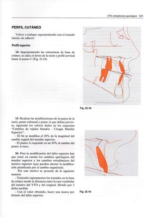 VTO ortodóncico-quirúrgico 531
PERFIL CUTÁNEO
Volver a trabajar superponiendo con el trazado
inicial, sin adherir:
Perfil superior
14- Superponiendo las estructuras de base de
cráneo, se calca el dorso de la nariz y perfil cervical
hasta el punto C (Fig. 22.18).
Fig. 22.18.
15-Realizar las modificaciones de la punta de la
nariz, punto subnasal y punto A que deban prever-
se, siguiendo los valores dados en los esquemas
"Cambios de tejidos blandos - Cirugía Maxilar
Superior":
- El Sn se modifica el 30% de la magnitud del
cambio sagital del maxilar superior.
- El punto A responde en un 50% al cambio del
punto A óseo.
16- Para la modificación del labio superior hay
que tener en cuenta los cambios quirúrgicos del
maxilar superior y los cambios ortodóncicos del
incisivo superior (que pueden afectar la modifica-
ción planificada por el cambio esqueletal).
Por este motivo se procede de la siguiente
manera:
- Teniendo superpuestos los trazados en la base
de cráneo medir la distancia entre la cara vestibular
del incisivo del VTO y del original. Dividir por 2
dicha medida
- Con el valor obtenido, hacer una marca por
delante del labio superior.
Fig. 22.19.
 