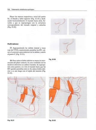 532 Tratamiento ortodóncico-quirúrgico
Hacer las marcas respectivas a nivel del punto
Sn, A blando y labio superior (Fig. 22.19) y desli-
zando horizontalmente el trazado hacia atrás, lle-
varlas a que se superpongan con la estructura
correspondiente del trazado original y calcarlas
(Fig. 22.20).
Perfil inferior:
17- Superponiendo las sínfisis (inicial y trazo
rojo del VTO), manteniendo paralelas las HV, cal-
car el contorno anteroinferior de la sínfisis y unirlo
al punto C (Fig. 22.21).
18-Para calcar el labio inferior se marca la inter-
sección del plano oclusal y la cara vestibular de los
incisivos inferiores en ambos trazados. Se superpo-
nen estos puntos y se rota el trazado hasta que las
HV queden paralelas entre sí. Se calca el labio infe-
rior y se une luego con el tejido del mentón (Fig.
22.22).
Fig. 22.20
Fig. 22.21 Fig. 22.22
 