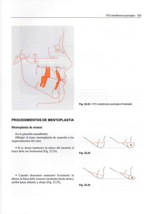 VTO ortodóncico-quirúrgico 533
Fig. 22.23: VTO ortodóncico-quirúrgico finalizado
PROCEDIMIENTOS DE MENTOPLASTIA
Mentoplastia de avance:
En la plantilla mandibular:
Dibujar el trazo mentoplastia de acuerdo a los
requerimientos del caso:
• Si se desea mantener la altura del mentón el
trazo debe ser horizontal (Fig. 22.24).
Fig. 22.24
• Cuando deseamos aumentar levemente la
altura, la línea debe trazarse inclinada desde atrás y
arriba hacia delante y abajo (Fig. 22.25).
Fig. 22.25
 