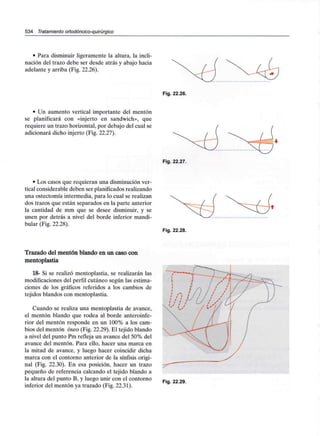 534 Tratamiento ortodóncico-quirúrgico
• Para disminuir ligeramente la altura, la incli-
nación del trazo debe ser desde atrás y abajo hacia
adelante y arriba (Fig. 22.26).
• Un aumento vertical importante del mentón
se planificará con «injerto en sandwich», que
requiere un trazo horizontal, por debajo del cual se
adicionará dicho injerto (Fig. 22.27).
Fig. 22.26.
Fig. 22.27.
• Los casos que requieran una disminución ver-
tical considerable deben ser planificados realizando
una ostectomía intermedia, para lo cual se realizan
dos trazos que están separados en la parte anterior
la cantidad de mm que se desee disminuir, y se
unen por detrás a nivel del borde inferior mandi-
bular (Fig. 22.28).
Fig. 22.28.
Trazado del mentón blando en un caso con
mentoplastia
18- Si se realizó mentoplastia, se realizarán las
modificaciones del perfil cutáneo según las estima-
ciones de los gráficos referidos a los cambios de
tejidos blandos con mentoplastia.
Cuando se realiza una mentoplastia de avance,
el mentón blando que rodea al borde anteroinfe-
rior del mentón responde en un 100% a los cam-
bios del mentón óseo (Fig. 22.29). El tejido blando
a nivel del punto Pm refleja un avance del 50% del
avance del mentón. Para ello, hacer una marca en
la mitad de avance, y luego hacer coincidir dicha
marca con el contorno anterior de la sínfisis origi-
nal (Fig. 22.30). En esa posición, hacer un trazo
pequeño de referencia calcando el tejido blando a
la altura del punto B, y luego unir con el contorno
inferior del mentón ya trazado (Fig. 22.31).
Fig. 22.29.
 