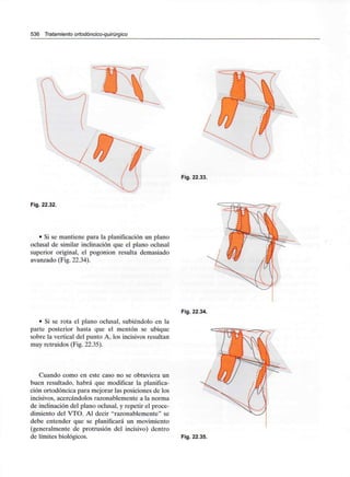 536 Tratamiento ortodóncico-quirúrgico
Fig. 22.33.
Fig. 22.32.
• Si se mantiene para la planificación un plano
oclusal de similar inclinación que el plano oclusal
superior original, el pogonion resulta demasiado
avanzado (Fig. 22.34).
Fig. 22.34.
• Si se rota el plano oclusal, subiéndolo en la
parte posterior hasta que el mentón se ubique
sobre la vertical del punto A, los incisivos resultan
muy retruidos (Fig. 22.35).
Cuando como en este caso no se obtuviera un
buen resultado, habrá que modificar la planifica-
ción ortodóncica para mejorar las posiciones de los
incisivos, acercándolos razonablemente a la norma
de inclinacióndel plano oclusal, y repetir el proce-
dimiento del VTO. Al decir "razonablemente" se
debe entender que se planificará un movimiento
(generalmente de protrusión del incisivo) dentro
de límites biológicos. Fig. 22.35.
 