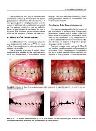 VTO ortodóncico-quirúrgico 537
Esta modificación hará que el resultado entre
discrepancia dentaria y modificación del incisivo
por protrusión-retrusión no dé como resultado O,
sino que sea positivo e implique realizar un trata-
miento ortodóncico más complejo (por ej, mesiali-
zar los sectores posteriores, para en definitiva
lograr un movimimeto de protrusión de toda la
arcada) o dejar diastemas que necesitarán de reha-
bilitación con implantes, prótesis o restauraciones.
PLANIFICACIÓN TRANSVERSAL
El problema transversal requiere una considera-
ción independiente, dado que el VTO no puede
reflejar los requerimientos ortodóncicos ni quirúr-
gicos en este sentido.
Para su estudio, se recurre al análisis clínico,
fotográfico y de modelos. En los pacientes asimé-
tricos, será indispensable la utilización de telerra-
diografía y trazado cefalométrico frontal, y radio-
grafía panorámica además de los elementos ante-
riormente mencionados
Coordinación de los diámetros transversos
El primer paso es evaluar la relación transversal
que tienen entre sí ambas arcadas. Si el paciente
presenta una anomalía sagital, la observación de la
boca o de los modelos iniciales montados en articu-
lador, no nos determinará si hay compatibilidad o
no de los diámetros transversos, por lo que se debe-
rán relacionar los modelos en la posición posqui-
rúrgica para poder evaluarlo.
Es común observar en un paciente de Clase III
una mordida cruzada posterior, y al relacionar los
modelos en Clase I ésta desaparece, lo cual indica
que no se deberá planificar ningún cambio trans-
versal en la parte posterior. Lo contrario, es decir,
Fig. 22.36 : Oclusión de Clase III, en un paciente que recibió tratamiento de expansión superior y se observa una rela-
ción transversal normal.
Fig. 22.37 : Los modelos del paciente de la fig. 22.36, al ser llevados a la relación posquirúrgica, muestran una clara
discrepancia transversal, se expresa una sobreexpansión del maxilar superior
 
