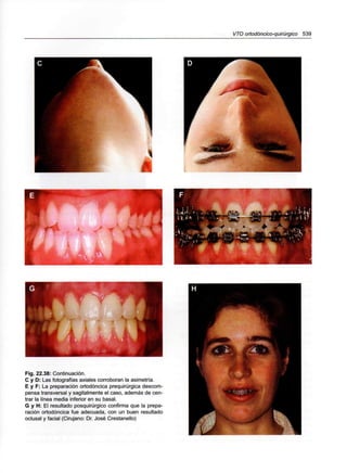 VTO ortodóncico-quirúrgico 539
Fig. 22.38: Continuación.
C y D: Las fotografías axiales corroboran la asimetría.
E y F: La preparación ortodóncica prequirúrgica descom-
pensa transversal y sagitalmente el caso, además de cen-
trar la línea media inferior en su basal.
G y H: El resultado posquirúrgico confirma que la prepa-
ración ortodóncica fue adecuada, con un buen resultado
oclusal y facial (Cirujano: Dr. José Crestanello)
 