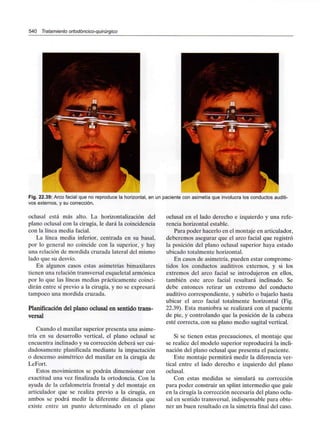 540 Tratamiento ortodóncico-quirúrgico
Fig. 22.39: Arco facial que no reproduce la horizontal, en un paciente con asimetía que involucra los conductos auditi-
vos externos, y su corrección.
oclusal está más alto. La horizontalización del
plano oclusal con la cirugía, le dará la coincidencia
con la línea media facial.
La línea media inferior, centrada en su basal,
por lo general no coincide con la superior, y hay
una relación de mordida cruzada lateral del mismo
lado que su desvío.
En algunos casos estas asimetrías bimaxilares
tienen una relación transversal esqueletal armónica
por lo que las líneas medias prácticamente coinci-
dirán entre sí previo a la cirugía, y no se expresará
tampoco una mordida cruzada.
Planificación del plano oclusal en sentido trans-
versal
Cuando el maxilar superior presenta una asime-
tría en su desarrollo vertical, el plano oclusal se
encuentra inclinado y su corrección deberá ser cui-
dadosamente planificada mediante la impactación
o descenso asimétrico del maxilar en la cirugía de
LeFort.
Estos movimientos se podrán dimensionar con
exactitud una vez finalizada la ortodoncia. Con la
ayuda de la cefalometría frontal y del montaje en
articulador que se realiza previo a la cirugía, en
ambos se podrá medir la diferente distancia que
existe entre un punto determinado en el plano
oclusal en el lado derecho e izquierdo y una refe-
rencia horizontal estable.
Para poder hacerlo en el montaje en articulador,
deberemos asegurar que el arco facial que registró
la posición del plano oclusal superior haya estado
ubicado totalmente horizontal.
En casos de asimetría, pueden estar comprome-
tidos los conductos auditivos externos, y si los
extremos del arco facial se introdujeron en ellos,
también este arco facial resultará inclinado. Se
debe entonces retirar un extremo del conducto
auditivo correspondiente, y subirlo o bajarlo hasta
ubicar el arco facial totalmente horizontal (Fig.
22.39). Esta maniobra se realizará con el paciente
de pie, y controlando que la posición de la cabeza
esté correcta, con su plano medio sagital vertical.
Si se tienen estas precauciones, el montaje que
se realice del modelo superior reproducirá la incli-
nación del plano oclusal que presenta el paciente.
Este montaje permitirá medir la diferencia ver-
tical entre el lado derecho e izquierdo del plano
oclusal.
Con estas medidas se simulará su corrección
para poder construir un splint intermedio que guíe
en la cirugía la corrección necesaria del plano oclu-
sal en sentido transversal, indispensable para obte-
ner un buen resultado en la simetría final del caso.
 