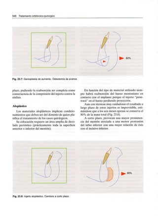 548 Tratamiento ortdóncico-quirúrgico
80%
Fig. 23.7: Genioplastia de aumento. Osteotomía de avance.
plazo, pudiendo la reabsorción ser completa como
consecuencia de la compresión del injerto contra la
sínfisis.
Aloplástico
Los materiales aloplásticos implican condicio-
namientos que deben ser del dominio de quien pla-
nifica el tratamiento de los casos quirúrgicos.
Su colocación requiere un área amplia de deco-
lado perióstico (prácticamente toda la superficie
anterior e inferior del mentón).
En función del tipo de material utilizado siem-
pre habrá reabsorción del hueso mentoniano en
contacto con el implante porque el injerto "pene-
trará" en el hueso perdiendo proyección.
Aun con técnicas muy cuidadosas el resultado a
largo plazo de estos injertos es imprevisible, esti-
mándose que a los seis meses apenas se conserva el
80% de la masa total (Fig. 23.8).
A corto plazo, provocan una mayor prominen-
cia del mentón asociada a una menor protrusión
del labio inferior con una mejor relación de éste
con el incisivo inferior.
80%
Fig. 23.8: Injerto aloplástico. Cambios a corto plazo.
 
