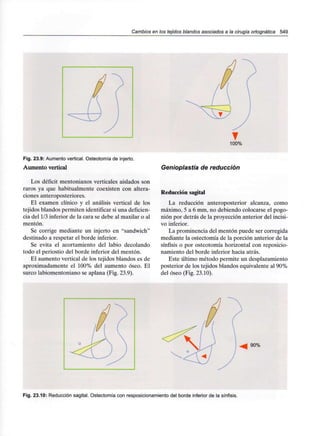 Cambios en los tejidos blandos asociados a la cirugía ortognática 549
Fig. 23.9: Aumento vertical. Osteotomía de injerto.
Aumento vertical
Los déficit mantórnanos verticales aislados son
raros ya que habitualmente coexisten con altera-
ciones anteroposteriores.
El examen clínico y el análisis vertical de los
tejidos blandos permiten identificar si una deficien-
cia del 1/3 inferior de la cara se debe al maxilar o al
mentón.
Se corrige mediante un injerto en "sandwich"
destinado a respetar el borde inferior.
Se evita el acortamiento del labio decolando
todo el periostio del borde inferior del mentón.
El aumento vertical de los tejidos blandos es de
aproximadamente el 100%del aumento óseo. El
surco labiomentoniano se aplana (Fig. 23.9).
Genioplastía de reducción
Reducción sagital
La reducción anteroposterior alcanza, como
máximo, 5 a 6 mm, no debiendo colocarse el pogo-
nión por detrás de la proyección anterior del incisi-
vo inferior.
La prominencia del mentón puede ser corregida
mediante la ostectomía de la porción anterior de la
sínfisis o por osteotomía horizontal con reposicio-
namiento del borde inferior hacia atrás.
Este último método permite un desplazamiento
posterior de los tejidos blandos equivalente al 90%
del óseo (Fig. 23.10).
90%
Fig. 23.10: Reducción sagital. Ostectomía con resposicionamiento del borde inferior de la sínfisis.
 