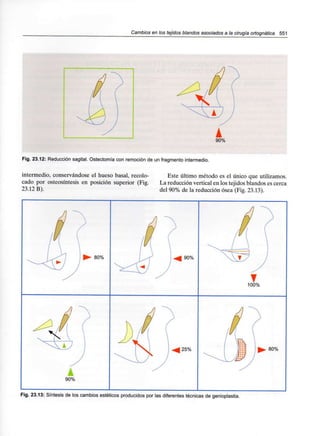 Cambios en los tejidos blandos asociados a la cirugía ortognática 551
Fig. 23.12: Reducción sagital. Ostectomía con remoción de un fragmento intermedio.
intermedio, conservándose el hueso basal, recoló- Este último método es el único que utilizamos,
cado por osteosíntesis en posición superior (Fig. La reducción verticalen los tejidosblandos es cerca
23.12 B). del 90% de la reducción ósea (Fig. 23.13).
80% 90%
90%
1 25% 80%
Fig. 23.13: Síntesis de los cambios estéticos producidos por las diferentes técnicas de genioplastia.
 