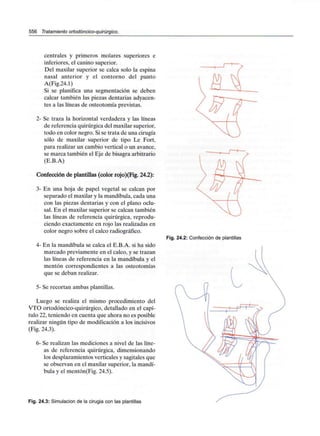 556 Tratamiento ortodóncico-quirúrgico.
centrales y primeros molares superiores e
inferiores, el canino superior.
Del maxilar superior se calca solo la espina
nasal anterior y el contorno del punto
A(Fig.24.1)
Si se planifica una segmentación se deben
calcar también las piezas dentarias adyacen-
tes a las líneas de osteotomía previstas.
2- Se traza la horizontal verdadera y las líneas
de referencia quirúrgicadel maxilar superior,
todo en color negro. Si se trata de una cirugía
sólo de maxilar superior de tipo Le Fort,
para realizar un cambio vertical o un avance,
se marca también el Eje de bisagra arbitrario
(E.B.A)
Confección de plantillas (color rojo)(Fig. 24.2):
3- En una hoja de papel vegetal se calcan por
separado el maxilar y la mandíbula, cada una
con las piezas dentarias y con el plano oclu-
sal. En el maxilar superior se calcan también
las líneas de referencia quirúrgica, reprodu-
ciendo exactamente en rojo las realizadas en
color negro sobre el calco radiográfico.
4- En la mandíbula se calca el E.B.A. si ha sido
marcado previamente en el calco, y se trazan
las líneas de referencia en la mandíbula y el
mentón correspondientes a las osteotomías
que se deban realizar.
5- Se recortan ambas plantillas.
Luego se realiza el mismo procedimiento del
VTO ortodóncico-quirúrgico, detallado en el capí-
tulo 22, teniendo en cuenta que ahora no es posible
realizar ningún tipo de modificación a los incisivos
(Fig. 24.3).
6- Se realizan las mediciones a nivel de las líne-
as de referencia quirúrgica, dimensionando
los desplazamientos verticales y sagitales que
se observan en el maxilar superior, la mandí-
bula y el mentón(Fig. 24.5).
Fig. 24.3: Simulación de la cirugía con las plantillas
Fig. 24.2: Confección de plantillas
 