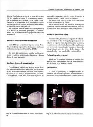 Planificación quirúrgica cefalométríca de modelos 563
abierta. Con la impactación de la superficie poste-
rior del maxilar, el punto A generalmente avanza,
con consecuencias estéticas en la región nasal.
Basado en la información de la simulación, el ciru-
jano decide si debe reducir la dimensión de la espi-
na nasal durante la intervención.
En cuanto al mentón, su corrección se planifica
en el trazado de predicción quirúrgica y se comple-
menta con la transferencia del pogonion al modelo
mandibular.
Medidas dentarias transversales
Con el bloque apoyado en la parte lateral dere-
cha, se miden y registran las distancias a las líneas
medias maxilar y mandibular (Fig. 24.12).
En casos de segmentación maxilar múltiple, se
miden y registran las distancias al primero y último
diente de cada segmento.
Medidas óseas transversales
Con el bloque apoyado en la parte lateral dere-
cha (siempre es el mismo lado de las medidas den-
tarias), se trazan dos líneas paralelas en la superfi-
cie posterior del modelo, perpendiculares a su base.
Corresponden, en los lados derecho e izquierdo de
los modelos superior e inferior respectivamente, a
las tuberosidades y a las ramas ascendentes.
En la superficie anterior de los modelos se traza
la línea media ósea (Fig. 24.13).
Estas referencias no son medidas. Sirven para
cuantificar las alteraciones transversales al finalizar
la simulación. Esta diferencia debe ser registrada.
Medidas interdentarias
Estas medidas, determinadas a partir de referen-
cias dentarias en las radiografías periapicales, se
refieren al espacio óseo disponible entre las raíces,
en las zonas de osteotomía. Las medidas se obtienen
con un compás o un calibrador manual en el espacio
interproximal, entre los ápices de los dientes y la
cresta alveolar y son transferidas a los modelos.
En la radiografía periapical
Medir, en el área interproximal, el espacio dis-
ponible entre los ápices y a nivel de la cresta alveo-
lar. Registrar en la hoja de trabajo.
En el modelo
1. Trazar el eje mayor y la cara proximal de las
raíces de los dientes adyacentes a la osteotomía /
ostectomía, basándose en la forma y en las medidas
Fig. 24.12: Medición transversal de la línea media denta-
ria.
Fig. 24.13 : Medición transversal de la línea media ósea
 