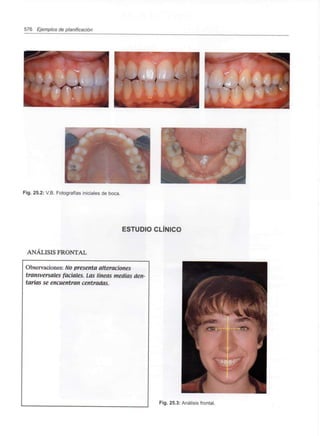 576 Ejemplos de planificación
Fig. 25.2: V.B. Fotografías iniciales de boca.
ESTUDIO CLÍNICO
ANÁLISIS FRONTAL
Observaciones: No presenta alteraciones
transversales faciales. Las líneas medias den-
tarias se encuentran centradas.
Fig. 25.3: Análisis frontal.
 