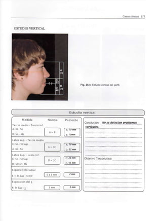 Casos clínicos 577
ESTUDIO VERTICAL
Fig. 25.4:Estudio vertical del perfil.
Estudio vertical
Medida
Tercio medio - Tercio inf.
A: Gl - Sn
B: Sn - Me
Norma
Labio sup.- Tercio medio
C: Sn - St Sup.
A: Gl - Sn
Labio Sup. - Labio inf.
C: Sn - St Sup
D: St Inf - Me
Espacio I nterlabial
E = StSup- St Inf
Exposición del 1_
F: StSup-1
Paciente
Conclusión: No se detectan problemas
Objetivo Terapéutico
 