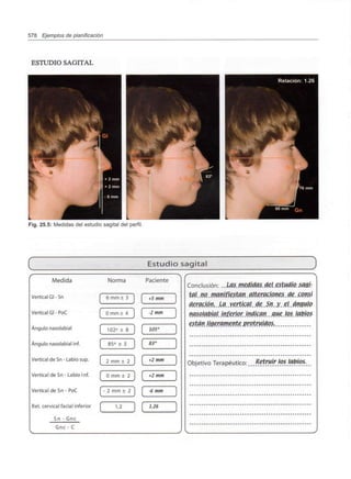 578 Ejemplos de planificación
ESTUDIO SAGITAL
Fig. 25.5: Medidas del estudio sagital del perfil.
Estudio sagital J
X*
Medida
Vertical Gl - Sn
Vertical Gl - PoC
Ángulo nasolabial
Ángulo nasolabial inf.
Vertical de Sn - Labio sup.
Vertical de Sn - Labio 1 nf.
Vertical de Sn - PoC
Reí. cervical facial inferior
Sn - Gnc
Gnc - C
V
Norma Paciente
6 mm± 3 +5 mm
0 mm± 4 -2 mm
102° ± 8 ]
85° ± 5 ]
105"
83°
2 mm + 2 ) +2 mm
0 mm ± 2 +2 mm
- 2 mm ± 2 1 -6 mm
i g i 1.26
N
/
/• ^v
Conclusión: .. Las. meOHtaS.del .estudio, sagj:
tal no manifiestan alteraciones ae consi
aeración. La vertical ae Sn y el ángulo
nasolabial inferior inaican que los labios
están ligeramente jjrotruiaos.
Objetivo Terapéutico: Retruir los labios.
. y
 