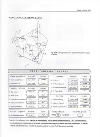 Casos clínicos 579
CEFALOGRAMA LATERAL BÁSICO
Fig. 25.6: Cefalograma inicial, a partir de la telerradiogra-
fía en MIC.
C E F A L O G R A M A L A T E R A L
J
Clase esqueletal Normal
01- Convexidad facial ( + 2 ± 2mm J
02- DistanciaA-B [ + 4 ± 2 m m ]
V
f Maxilar Inferior Normal
03- Eje Facial [ yu ± i )
04- Prof. Facial ( 87°± 3° ]
05- Ang.plano mandibular [ 26° ± 4° J
06- Altura facial inferior ( 47°± 4° ]
07- Arco mandibular ( 26° ± 4° J
V
Maxilar Superior Normal
08- Profundidad maxilar ( 90° ± 3° J
V
 nicial
í 5,1 mm }
í 4 mm J
J
N
1 nicial
í 89,7' 1
( 87,5° ]
[ 26,2° J
í 46,8° ]
[ 23,9° ]
J
• nicial
[ 92,5° J
J
Dientes
09- 1 - A-Po [_
10- 1 - Plano Oclusal [_
11-1 - Plano mandibular _
fil
12- 1 - Plano BaNa [«
^
s
Estética
13- Exposición del 1 [+
14- Labioinf. Plano E [_
15- Ángulo nasolabialInf. [_
V
Biotipo facial
VERI [-0,1 ] mesofacial
V
^l 1 nicial
+ 1 ± 2mm] ( Smm }
+ 1 ± 1 mm ] ( -lmm }
90° ± 5° J ( 104,2
c e c 1 í 93° }
E. Fac. -5° J [ J
J
Normal 1 nicial
2.5a+3mm] ( +3 mm ]
- 2 ± 2mm) ( '^ "« ]
85° ± 5° ] [ 83'8° }
J
Paciente grupo:
dD
Descripción cefalométrica: Paciente de sexo femenino, sin crecimiento, biotipo mesofacial. Clase II esqueletal leve,
con Clase I alveolar. Maxilar superior avanzado, mandíbula en normoposición. Buena relación de los maxilares en sentido
vertical. Clase I dentaria con biprotrusión incisivay falta de overbite. Perfil ligeramente protruido.
 