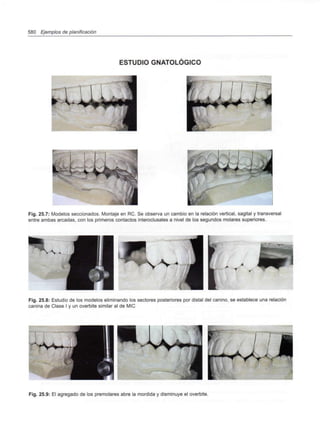 580 Ejemplos de planificación
ESTUDIO GNATOLÓGICO
ffi
•
k. 1 v^
U
Fig. 25.7: Modelos seccionados. Montaje en RC. Se observa un cambio en la relación vertical, sagital y transversal
entre ambas arcadas, con los primeros contactos interoclusales a nivel de los segundos molares superiores.
Fig. 25.8: Estudio de los modelos eliminando los sectores posteriores por distal del canino, se establece una relación
canina de Clase I y un overbite similar al de MIC
_
Fig. 25.9: El agregado de los premolares abre la mordida y disminuye el overbite.
 