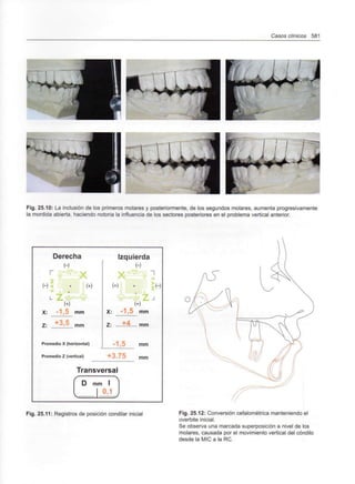 Casos clínicos 581
B^j
Fig. 25.10: La inclusión de los primeros molares y posteriormente, de los segundos molares, aumenta progresivamente
la mordida abierta, haciendo notoria la influencia de los sectores posteriores en el problema vertical anterior.
Z: +3,5 mm
Izquierda
X: -1,5 mm
Z: ±á mm
Promedio X (horizontal)
Promedio Z (vertical)
Transversal
mm
mm
mm I
Fig. 25.11: Registros de posición condilar inicial Fig. 25.12: Conversión cefalométrica manteniendo el
overbite inicial.
Se observa una marcada superposición a nivel de los
molares, causada por el movimiento vertical del cóndilo
desde la MIC a la RC.
 