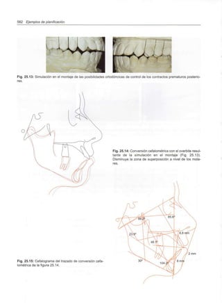 582 Ejemplos de planificación
Fig. 25.13: Simulación en el montaje de las posibilidades ortodóncicas de control de los contractos prematuros posterio-
res.
Fig. 25.14: Conversión cefalométrica con el overbite resul-
tante de la simulación en el montaje (Fig. 25.13).
Disminuye la zona de superposición a nivel de los mola-
res.
Fig. 25.15: Cefalograma del trazado de conversión cefa-
lométrica de la figura 25.14.
2 mm
 