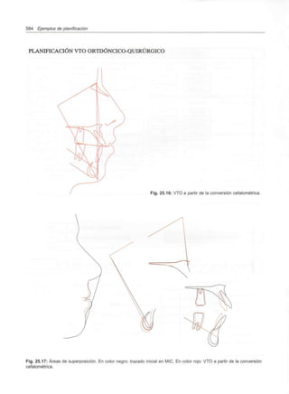 584 Ejemplos de planificación
PLANIFICACIÓN VTO ORTDÓNCICO-QUIRÚRGICO
Fig. 25.16: VTO a partir de la conversión cefalométrica.
Fig. 25.17: Áreas de superposición. En color negro: trazado inicial en MIC. En color rojo: VTO a partir de la conversión
cefalométrica.
 