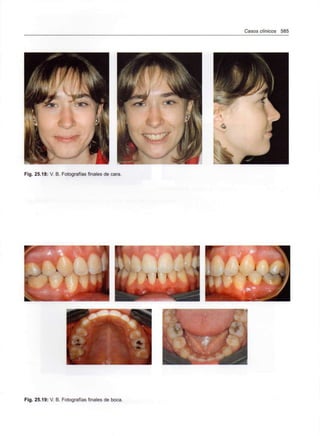 Casos clínicos 585
. 25.18: V. B. Fotografías finale
Fig. 25.19: V. B. Fotografías finales de boca.
 