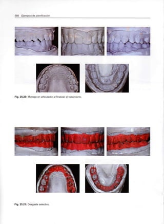 586 Ejemplos de planificación
Fig. 25.20: Montaje en articulador al finalizar el tratamiento.
Fig. 25.21: Desgaste selectivo.
 