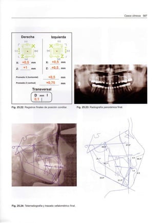 Casos clínicos 587
Derecha
(-)
P ^íf^-o^
¡,
(-) % K+)
~w
X: +0,5 mm
Z: mm
Promedio X (horizontal)
Promedio Z (vertical)
Izquierda
(-)
- ~~l
«i
"l~/ 9 yt 
^isr JL, -I
(+)
X: +0,5 mm
Z: ...+0.,.5... mm
+0,5 mm
+0,75 mm
Transversal
( D m
^ 0,1
TI I ^|
Fig. 25.22: Registros finales de posición condilar. Fig. 25.23: Radiografía panorámica final.
Fig. 25.24: Telerradiografía y trazado cefalometrico final.
 