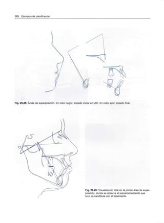 588 Ejemplos de planificación
Fig. 25.25: Áreas de superposición. En color negro: trazado inicial en MIC. En color azul: trazado final.
Fig. 25.26: Visualización total en la primer área de super-
posición, donde se observa el reposicionamiento que
tuvo la mandíbula con el tratamiento.
 