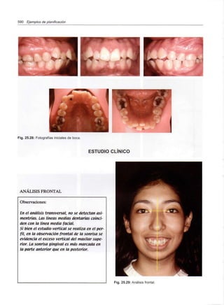 590 Ejemplos de planificación
I
Fig. 25.28: Fotografías iniciales de boca.
ESTUDIO CLÍNICO
ANÁLISIS FRONTAL
Observaciones:
En el análisis transversal, no se detectan asi-
mentrías. Las líneas medias dentarias coinci-
den con la línea media facial.
Si bien el estudio vertical se realiza en elper-
fil, en la observación frontal de la sonrisa se
evidencia el exceso vertical del maxilar supe-
rior. Lasonrisa gingival es más marcada en
la parte anterior que en la posterior.
Fig. 25.29: Análisis frontal.
 
