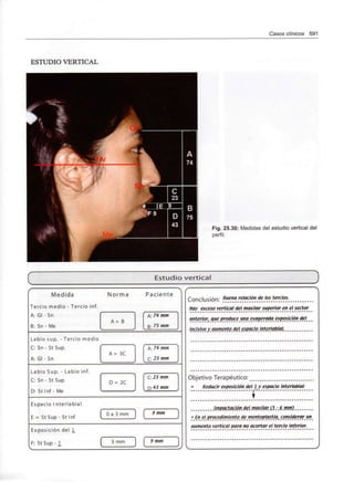 Casos clínicos 591
ESTUDIO VERTICAL
Fig. 25.30: Medidas del estudio vertical del
perfil.
Estudio vertical
Conclusión: Buena relación de los tercios.
Hay exceso vertical del maxilar superior en el sector
anterior, que Produce una exagerada exposición del
'"fjsiyo. y.flwweMtp.de/espacio Jnterlgbiql.
Objetivo Terapéutico: __
Reducir exposición del ly espacio interlabial
......... Jmpactacjón.del maxilar.(5.-.6mm) ........
•_£n el procedimiento de.mentop/qstttj, considerar un
aumento vertical para no acortar el tercio inferior.
 