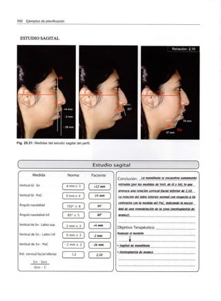 592 Ejemplos de planificación
ESTUDIO SAGITAL
Fig. 25.31: Medidas del estudio sagital del perfil.
Estudio sagital
Medida Norma Paciente
6 mm ± 3
[ O mm ± 4 ] f
Vertical Gl-Sn
Vertical Gl - PoC
Ángulo nasolabial
Ángulo nasolabial inf. 85° ± 5
Vertical de Sn- Labio sup. 2 mm ± 2
mm
mm
c 102° ± 8 94°
O mm ± 2
Vertical de Sn - Labio Inf.
Vertical de Sn - PoC - 2 mm ± 2 1
Reí. cervical facial inferior
S n - G n c
Gnc - C
1,2
Conclusión' ^-a. mandíbula se encuentra sumamente
retraída (P_or_las_medi_d_a_s_ de Vert. de Gly.Sn)^ lo.que..
Br.Qv.o.c.g_una_re,l_a_c_i0n_ cerMicaJ-.fqciaJ .inferior de.¿Jft..
4<? relación del. labio, inferior, normal con respecto a S.n
contrasta.con la.medida delPoC^ indicandQ.la necesi-..
dad.de .una.re.modelación.de.la.zona,ímentoplastia. de.
avance)..
Objetivo Terapéutico:
Avanz_a/_ el mentón
:i:
'.Mentopja.stiq _d_e avance.
 