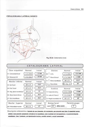 Casos clínicos 593
CEFALOGRAMA LATERAL BÁSICO
8 mm
Fig. 25.32: Cefalometría inicial.
C E F A L O G R A M A L A T E R A L
Clase esqueletal Normal I nidal
01-Convexidad facial ( + 2± 2mm J [ * 12 mm J
02- Distancia A-B 4± 2mm 20 mm
Maxilar I nferior Normal
03- Eje Facial
04-Prof. Facial í 87° ±3°
I nicial
( 90° ±3° ] [ 75.8"
C
76A°
05- Ang. plano mandibular [ 26° ± 4°
06- Altura facial inferior [ 47° ±4°
07- Arco mandibular
42°
26,Q±4° J [ 30.2° )
Dientes Normal I nicial
09- 1 - A-Po [ + 1± 2mm ] [ +13.5mm }
+ 1 ± 1mm ]
+ 1 mm
10- 1 - PlanoOclusal
11- 1 - Plano mandibular [ 90° ± 5° J [ 111A°
12- 1 - Plano BaNa (// E. Fac. -5° ) [ 85' }
Estética
13- Exposición del ]_
14- Labio inf. Plano E
Normal
2.5a+3mm
- 2 ± 2 m m
nicial
+ 9 mm
15-Ángulo nasolabia 1 1 nf. [ 85° ±5° ]
+ 8 mm
80°
Maxilar Superior Normal Inicial
08- Profundidad maxilar [ 90°± 3° J [ 87°
Biotipo facial Paciente grupo:
VERT -3.5 1 dólico severo f~3 1
Descripción cefalométrica: Paciente de sexo femenino, sin crecimiento, aue presenta una Clase II esaueletal severa
debida a una posición sumamente retruida de la mandíbula, como resultado del micrognatismo y la posterorrotación
mandibular. Clase I dentaria, con biprotrusión incisiva, overbite normal y overjet aumentado
 