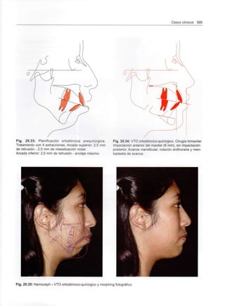 Casos clínicos 595
Fig. 25.33: Planificación ortodóncica prequirúrgica.
Tratamiento con 4 extracciones. Arcada superior: 2,5 mm
de retrusión - 2,5 mm de mesialización molar.
Arcada inferior: 2,5 mm de retrusión - anclaje máximo
Fig. 25.34: VTO ortodóncico-quirúrgico. Cirugía bimaxilar.
Impactación anterior del maxilar (6 mm), sin impactación
posterior. Avance mandibular, rotación antihoraria y men-
toplastia de avance.
Fig. 25.35: Nemoceph - VTO ortodóncico-quirúrgico y morphing fotográfico.
 