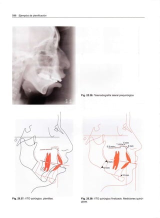 596 Ejemplos de planificación
Fig. 25.36: Telerradiografía lateral prequirúrgica
Fig. 25.37: VTO quirúrgico, plantillas. Fig. 25.38: VTO quirúrgico finalizado. Mediciones quirúr-
gicas.
 