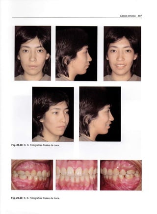 Casos clínicos 597
Fig. 25.39: S. S. Fotografías finales de cara.
Fig. 25.40: S. S. Fotografías finales de boca.
 