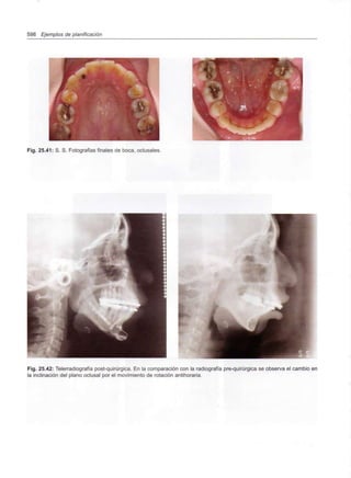598 Ejemplos de planificación
Fig. 25.41: S. S. Fotografías finales de boca, oclusales.
,
,
Fig. 25.42: Telerradiografía post-quirúrgica. En la comparación con la radiografía pre-quirúrgica se observa el cambio en
la inclinación del plano oclusal por el movimiento de rotación antihoraria.
 