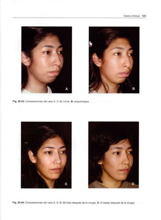 Casos clínicos 599
Fig. 25.43: Comparaciones del caso S. S. A: Inicial, B: prequirúrgica.
Fig. 25.44: Comparaciones del caso S. S. C: 60 días después de la cirugía. D: 8 meses después de la cirugía.
 