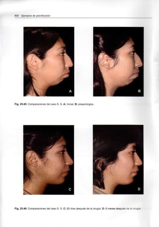 600 Ejemplos de planificación
Fig. 25.45: Comparaciones del caso S. S. A: Inicial, B: prequirúrgica.
Fig. 25.46: Comparaciones del caso S. S. C: 60 días después de la cirugía. D: 8 meses después de la cirugía.
 