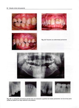 62 Estudio clínico del paciente
Fig. 2.5: Paciente con enfermedad periodontal
Fig. 2.6: La radiografía panorámica permite sólo una evaluación superficial del estado periodontal. Con las tomas peria-
picales se obtiene una mejor definición del problema.
 