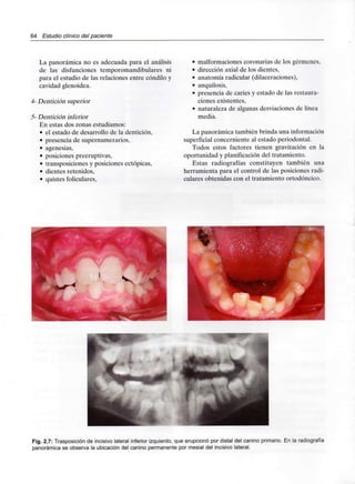 64 Estudio clínico del paciente
La panorámica no es adecuada para el análisis
de las disfunciones temporomandibulares ni
para el estudio de las relaciones entre cóndilo y
cavidad glenoidea.
4- Dentición superior
5- Dentición inferior
En estas dos zonas estudiamos:
• el estado de desarrollo de la dentición,
• presencia de supernumerarios,
• agenesias,
• posiciones preeruptivas,
• transposiciones y posiciones ectópicas,
• dientes retenidos,
• quistes foliculares,
• malformaciones coronarias de los gérmenes,
• dirección axial de los dientes,
• anatomía radicular (dilaceraciones),
• anquilosis,
• presencia de caries y estado de las restaura-
ciones existentes,
• naturaleza de algunas desviaciones de línea
media.
La panorámica también brinda unainformación
superficial concerniente al estado periodontal.
Todos estos factores tienen gravitación en la
oportunidad y planificación del tratamiento.
Estas radiografías constituyen también una
herramienta para el control de las posiciones radi-
culares obtenidas con el tratamiento ortodóncico.
Fig. 2.7: Trasposición de incisivo lateral inferior izquierdo, que erupcionó pordistal del canino primario. En la radiografía
panorámica se observa la ubicación del canino permanente por mesial del incisivo lateral.
 