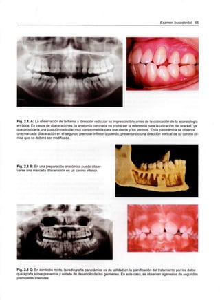 Examen bucodental 65
Fig. 2.8. A: La observación de la forma y dirección radicular es imprescindible antes de la colocación de la aparatología
en boca. En casos de dilaceraciones, la anatomía coronaria no podrá ser la referencia para la ubicación del bracket, ya
que provocaría una posición radicular muy comprometida para ese diente y los vecinos. En la panorámica se observa
una marcada dilaceración en el segundo premolar inferior izquierdo, presentando una dirección vertical de su corona clí-
nica que no deberá ser modificada.
Fig. 2.8 B: En una preparación anatómica puede obser-
varse una marcada dilaceración en un canino inferior.
,r*~,m *
Fig. 2.8 C: En dentición mixta, la radiografía panorámica es de utilidad en la planificación del tratamiento por los datos
que aporta sobre presencia y estado de desarrollo de los gérmenes. En este caso, se observan agenesias de segundos
premolares inferiores.
 
