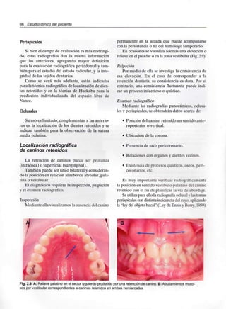 66 Estudio clínico del paciente
Periapicales
Si bien el campo de evaluación es más restringi-
do, estas radiografías dan la misma información
que las anteriores, agregando mayor definición
para la evaluación radiográfica periodontal y tam-
bién para el estudio del estado radicular, y la inte-
gridad de los tejidos dentarios.
Como se verá más adelante, están indicadas
para la técnica radiográfica de localización de dien-
tes retenidos y en la técnica de Huckaba para la
predicción individualizada del espacio libre de
Nance.
Oclusales
Su uso es limitado; complementan a las anterio-
res en la localización de los dientes retenidos y se
indican también para la observación de la sutura
media palatina.
Localización radiográfica
de caninos retenidos
La retención de caninos puede ser profunda
(intraósea) o superficial(subgingival).
También puede ser uni o bilateral y consideran-
do la posición en relación al reborde alveolar, pala-
tina o vestibular.
El diagnósticorequiere la inspección, palpación
y el examen radiográfico.
Inspección
Mediante ella visualizamos la ausencia del canino
permanente en la arcada que puede acompañarse
con la persistencia o no del homólogo temporario.
En ocasiones se visualiza además una elevación o
relieve en el paladar o en la zona vestibular (Fig.2.9).
Palpación
Por medio de ella se investiga la consistencia de
esa elevación. En el caso de corresponder a la
retención dentaria, su consistencia es dura. Por el
contrario, una consistencia fluctuante puede indi-
car un proceso infeccioso o quístico.
Examen radiográfico
Mediante las radiografías panorámicas, oclusa-
les y periapicales, se obtendrán datos acerca de:
• Posición del canino retenido en sentido ante-
roposterior o vertical.
• Ubicación de la corona.
• Presencia de sacopericoronario.
• Relacionescon órganos y dientes vecinos.
• Existenciade procesos quísticos. óseos, peri-
coronarios. etc.
Es muy importante verificar radiográficamente
la posición en sentido vestíbulo-palatino del canino
retenido con el fin de planificar la vía de abordaje.
Se utilizapara ello la radiografía oclusal y lastomas
periapicales con distinta incidencia del rayo,aplicando
la "ley del objeto bucal" (Ley de Ennisy Bern. 1959).
.2.9. A: Relieve palatino en el sector izquierdo producido por una retención de
sos por vestibular correspondientes a caninos retenidos en ambas hemiarcadas
 
