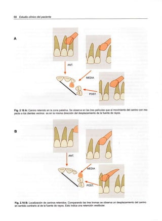 68 Estudio clínico del paciente
Fig. 2 10 A: Canino retenido en la zona palatina. Se observa en las tres películas que el movimiento del canino con res-
pecto a los dientes vecinos es en la misma dirección del desplazamiento de la fuente de rayos.
B
Fig. 2.10 B: Localización de caninos retenidos. Comparando las tres tromas se observa un desplazamiento del canino
en sentido contrario al de la fuente de rayos. Esto indica una retención vestibular.
 