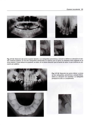 Examen bucodental 69
Fig. 2.11 A: Retención del canino superior derecho. Las radiografías panorámica y oclusal no definen su ubicación en sen-
tido vestíbulo-palatina. En las tres radiografías periapicales se observa que el canino se desplaza hacia adelante en la
toma anterior y hacia atrás en la posterior, es decir, en la misma dirección que la fuente de rayos, lo que confirma su ubi-
cación por palatino.
Fig. 2.11 B: Retención de canino inferior. La toma
de dos radiografías, panorámica y oclusal inferior,
define su ubicación con exactitud. La radiografía
periapical es sólo un complemento.
 