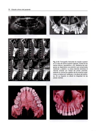 70 Estudio clínico del paciente
Fig. 2.12: Tomografía helicoidal de maxilar superior
en un caso de canino superior retenido. Cortes en los
planos oblicuo, panorámico y 3D. Mediante las imá-
genes se diagnostica una posición que compromete
vestibular y palatino. La pieza retenida atraviesa el
reborde alveolar por mesial del primer premolar,
estando su corona por palatino de los incisivos supe-
riores y el ápice por vestibular, a la altura del premo-
lar. En su trayecto no afectó la integridad de las
piezas vecinas.
 