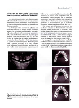 Examen bucodental 71
Utilización de Tomografía Computada
en el diagnóstico de caninos retenidos
Los métodos mencionados anteriormente para
la localización de caninos, si bien pueden ubicarlo
con bastante certeza, no siempre logran diagnosti-
car si existe daño en las raíces que se relacionan con
el diente retenido.
El diente que sufre reabsorción radicular con
mayor frecuencia es el incisivo lateral; el incisivo
central y los premolares también suelen estar afec-
tados , dependiendo de la posición del canino rete-
nido. Si la reabsorción involucra la parte apical
completa, o las caras proximales de la raíz, será visi-
ble en las radiografías de rutina, periapicales y
panorámica. La radiografía oclusal generalmente
no aporta datos en este aspecto. Pero en algunos
casos, cuando la incidencia de la pieza retenida
afecta solamente la cara palatina o vestibular de la
raíz, pueden existir reabsorciones que no son perci-
bidas en las tomas radiogáficas mencionadas. En
estos casos, el estudio podrá ser profundizado con
la tomografía axial computada que en los cortes
horizontales muestra la relación que se establece
entre el diente retenido y las raíces contiguas, cual-
quiera sea la relación espacial que se establezca
entre ellas, pudiendo así ser evaluadas (Fig. 2.13).
Este estudio será útil en todos los casos en que
se observe contacto del diente retenido con raíces
próximas, en los casos donde ya se observa reab-
sorción, para evaluar mejor el grado de compromi-
so, y en los casos donde no se observa, para descar-
tar totalmente la lesión. Además define con gran
exactitud la posición del canino, aunque general-
mente no sea éste el motivo de su prescripción.
La tomografía computada helicoidal amplía las
posibilidades de visualizaciónde dientes retenidos,
y con el complemento de procesador de imágenes
en estación de trabajo independiente se logran imá-
genes de 3D de alta resolución (Fig. 2.12).
Fig. 2.13: Retención de ambos caninos superiores.
Imágenes de la radiografía panorámica y de los cortes de
la TAC, donde se visualiza el compromiso de las raíces
próximas.
 