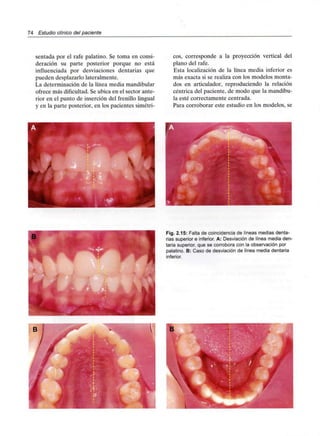 74 Estudio clínico del paciente
sentada por el rafe palatino. Se toma en consi-
deración su parte posterior porque no está
influenciada por desviaciones dentarias que
pueden desplazarlo lateralmente.
La determinación de la línea media mandibular
ofrece más dificultad.Se ubica en el sector ante-
rior en el punto de inserción del frenillo lingual
y en la parte posterior, en los pacientes simétri-
cos, corresponde a la proyección vertical del
plano del rafe.
Esta localización de la línea media inferior es
más exacta si se realiza con los modelos monta-
dos en articulador, reproduciendo la relación
céntrica del paciente, de modo que la mandíbu-
la esté correctamente centrada.
Para corroborar este estudio en los modelos, se
Fig. 2.15: Falta de coincidencia de líneas medias denta-
rias superior e inferior. A: Desviación de línea media den-
taria superior, que se corrobora con la observación por
palatino. B: Caso de desviaciónde línea mediadentaria
inferior.
 